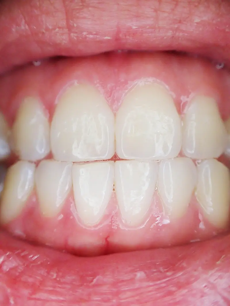 frankincense for teeth gums and oral health the natural